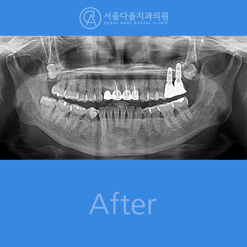 후