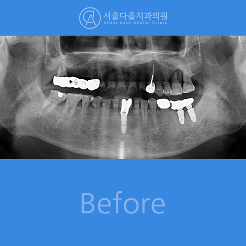 전