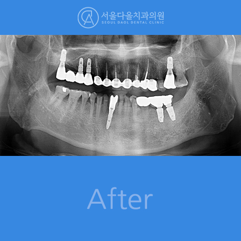 후