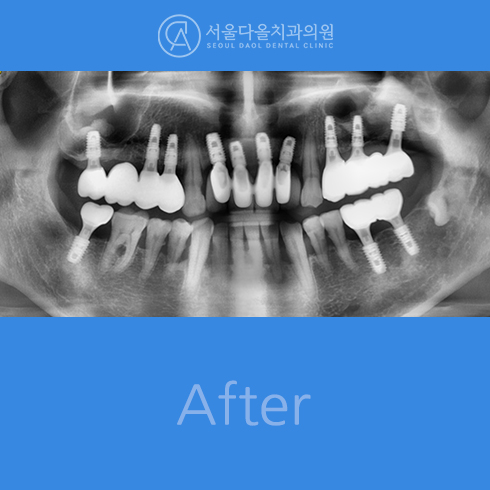 후