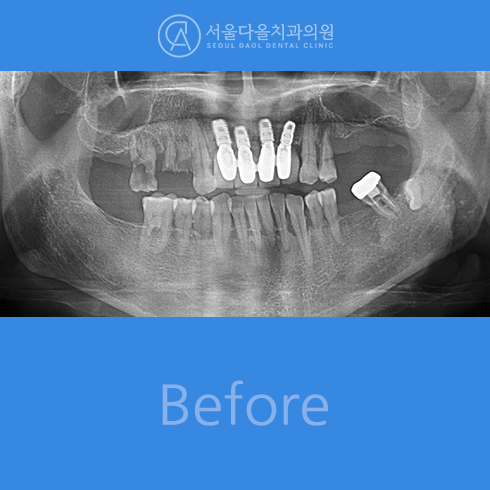 전