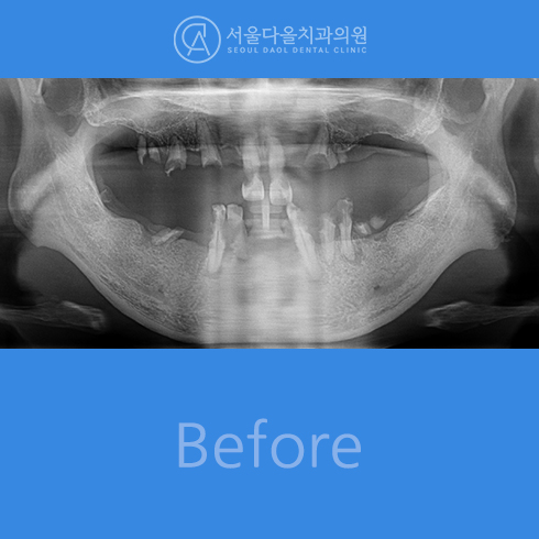 전