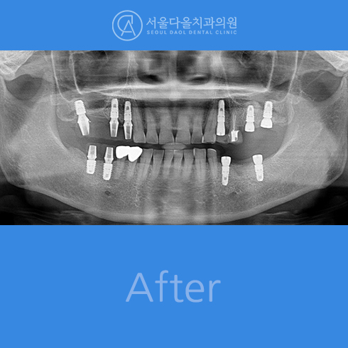 후